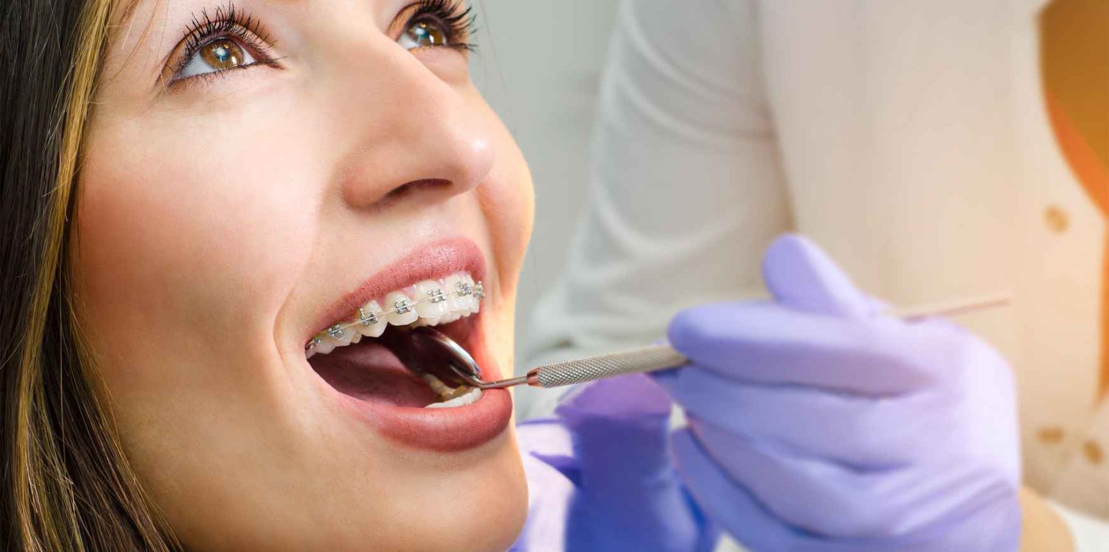 Clear aligners Melbourne