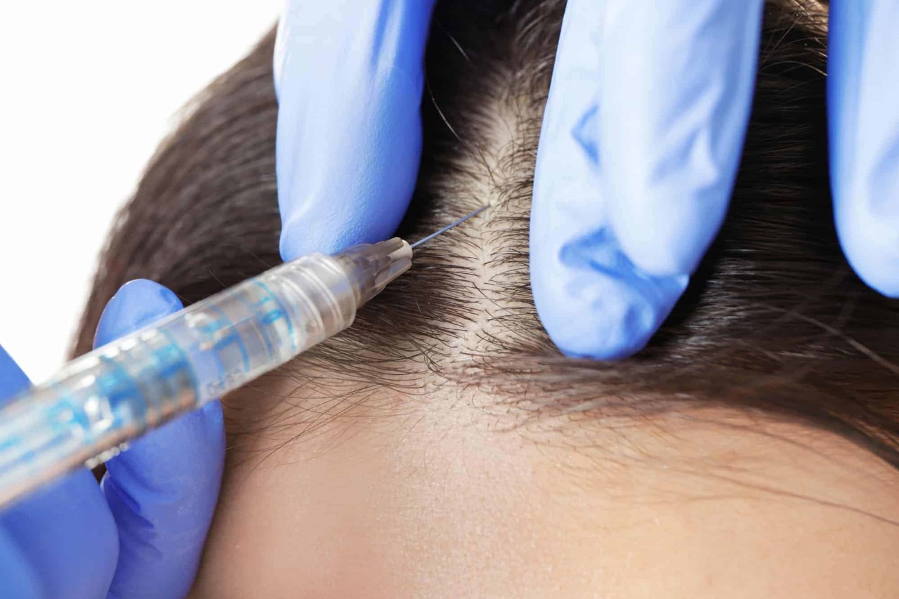 Hair transplant uk